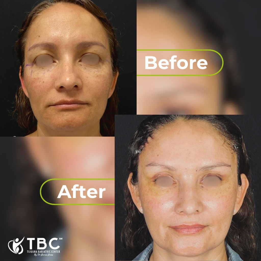Plastic surgery before and after patient photo