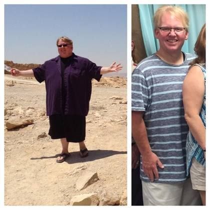 Bariatric Surgery Before & After Gallery - Patient 410483 - Image 1