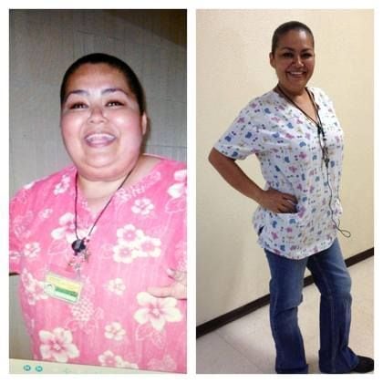 Bariatric Surgery Before & After Gallery - Patient 238213 - Image 1