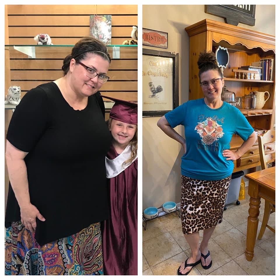 Bariatric surgery patient before and after