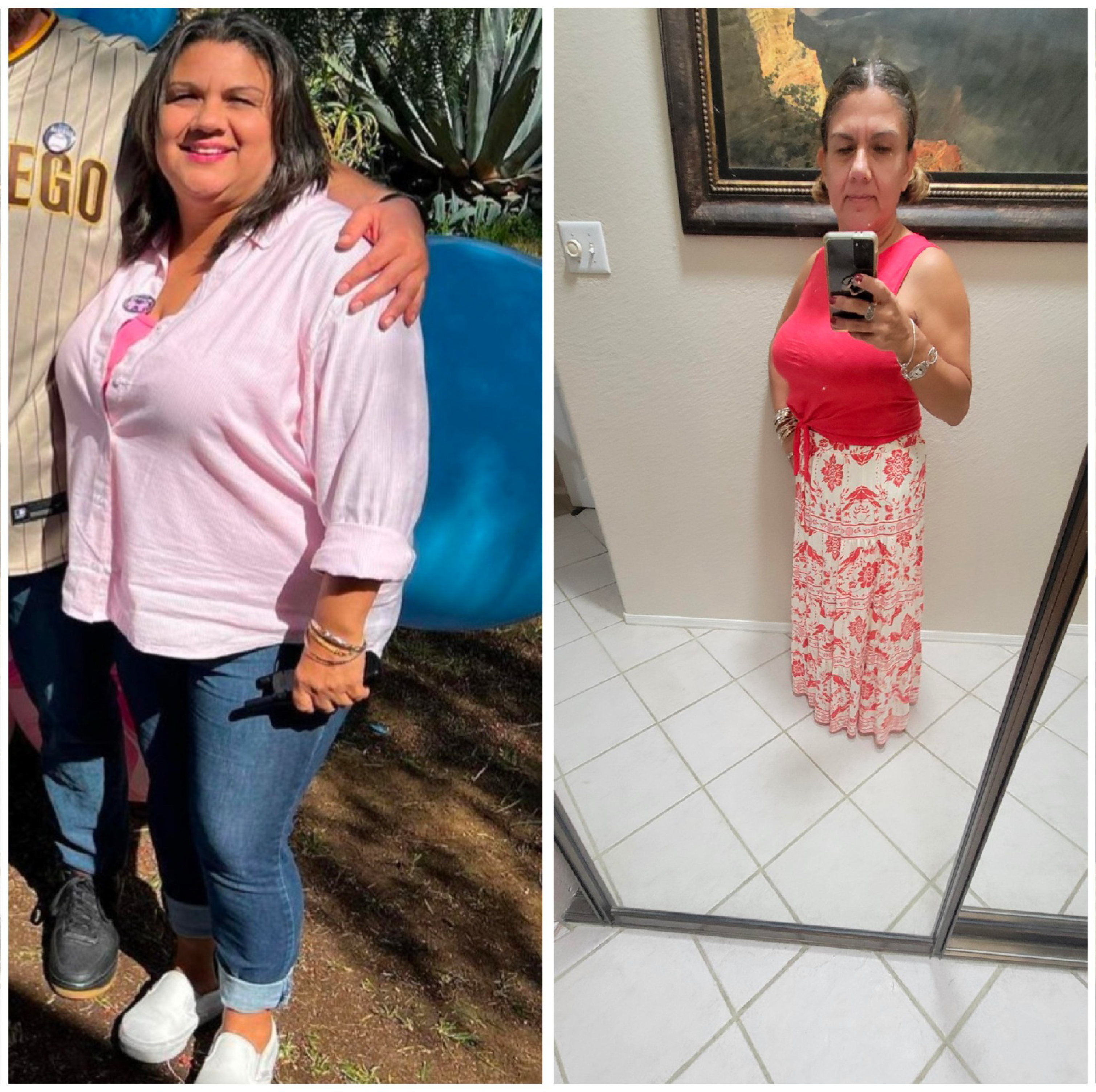 Bariatric Surgery Before & After Gallery - Patient 341242 - Image 1