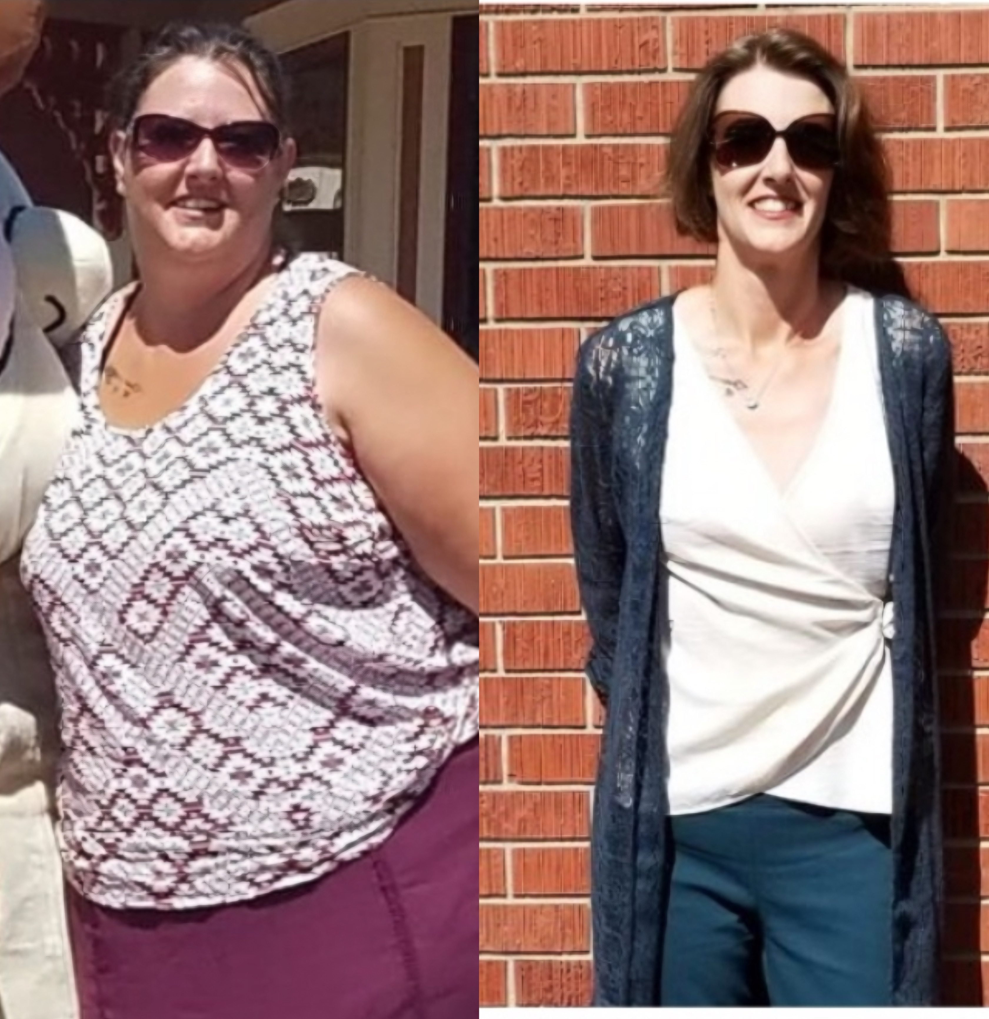 Bariatric Surgery Before & After Gallery - Patient 428224 - Image 1