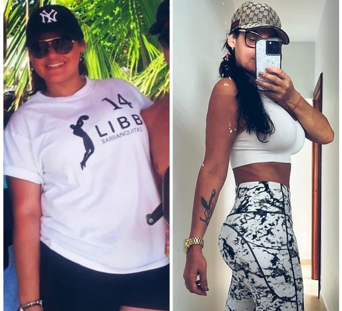 Bariatric Surgery Before & After Gallery - Patient 368528 - Image 1