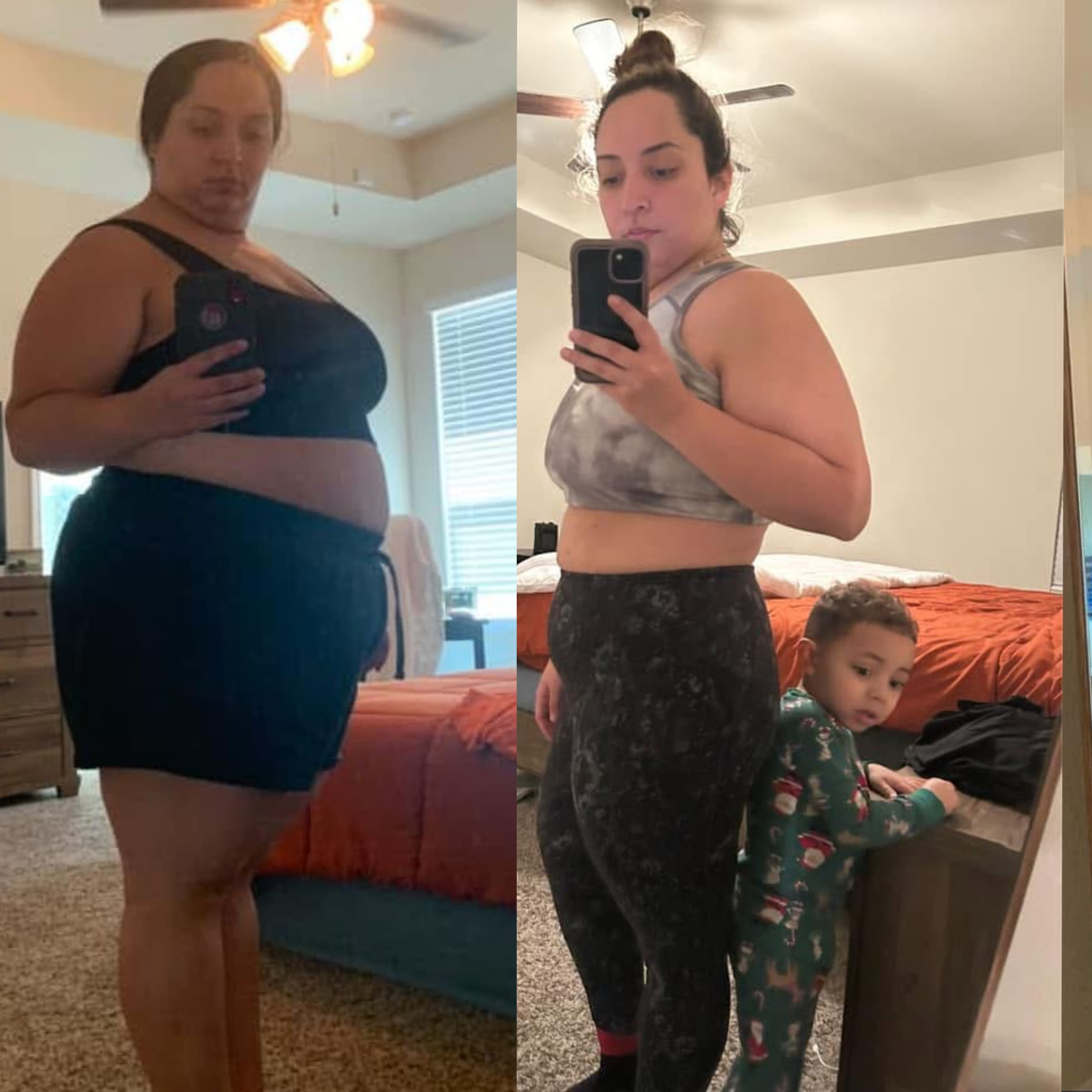 Bariatric Surgery Before & After Gallery - Patient 805520 - Image 1