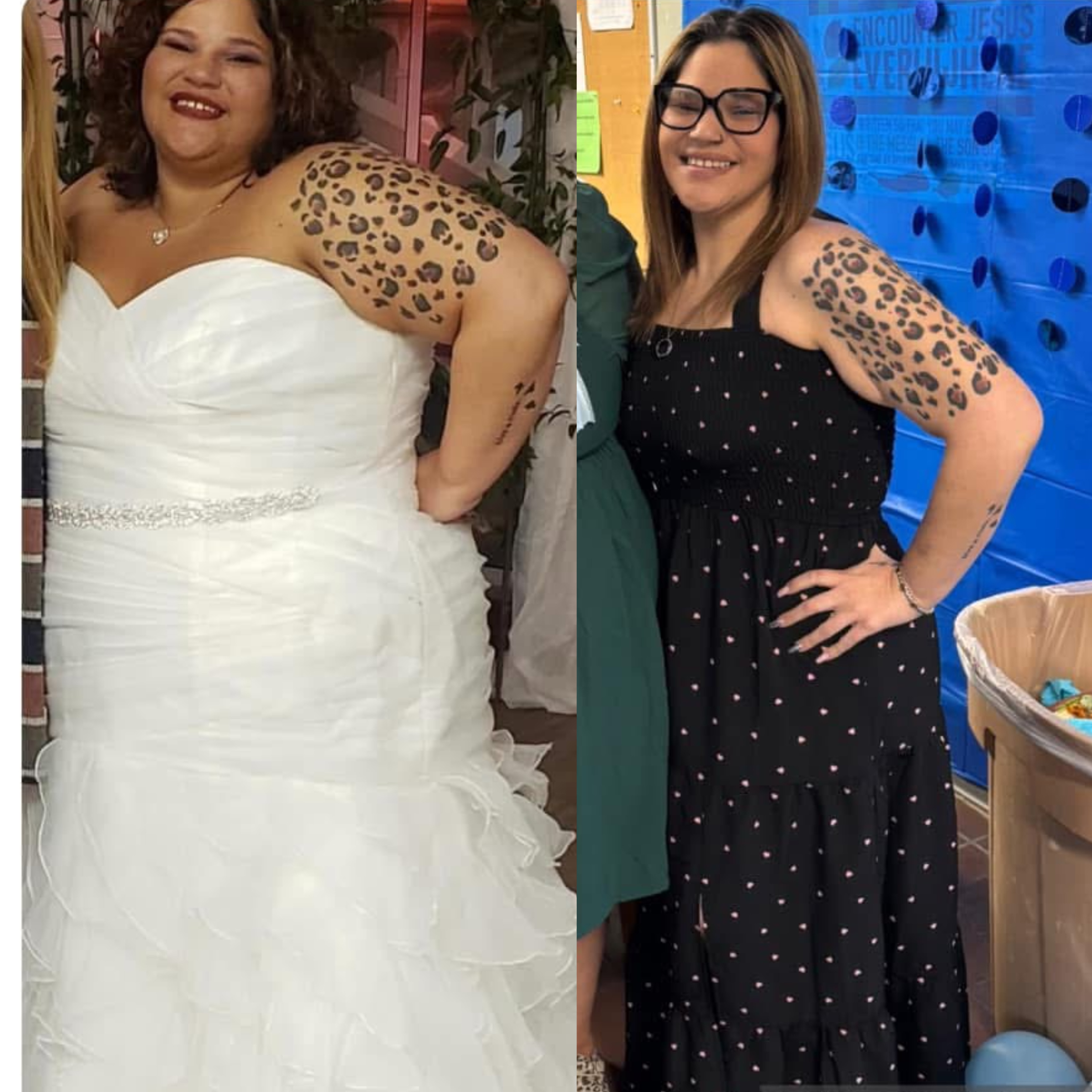 Bariatric Surgery Before & After Gallery - Patient 228996 - Image 1