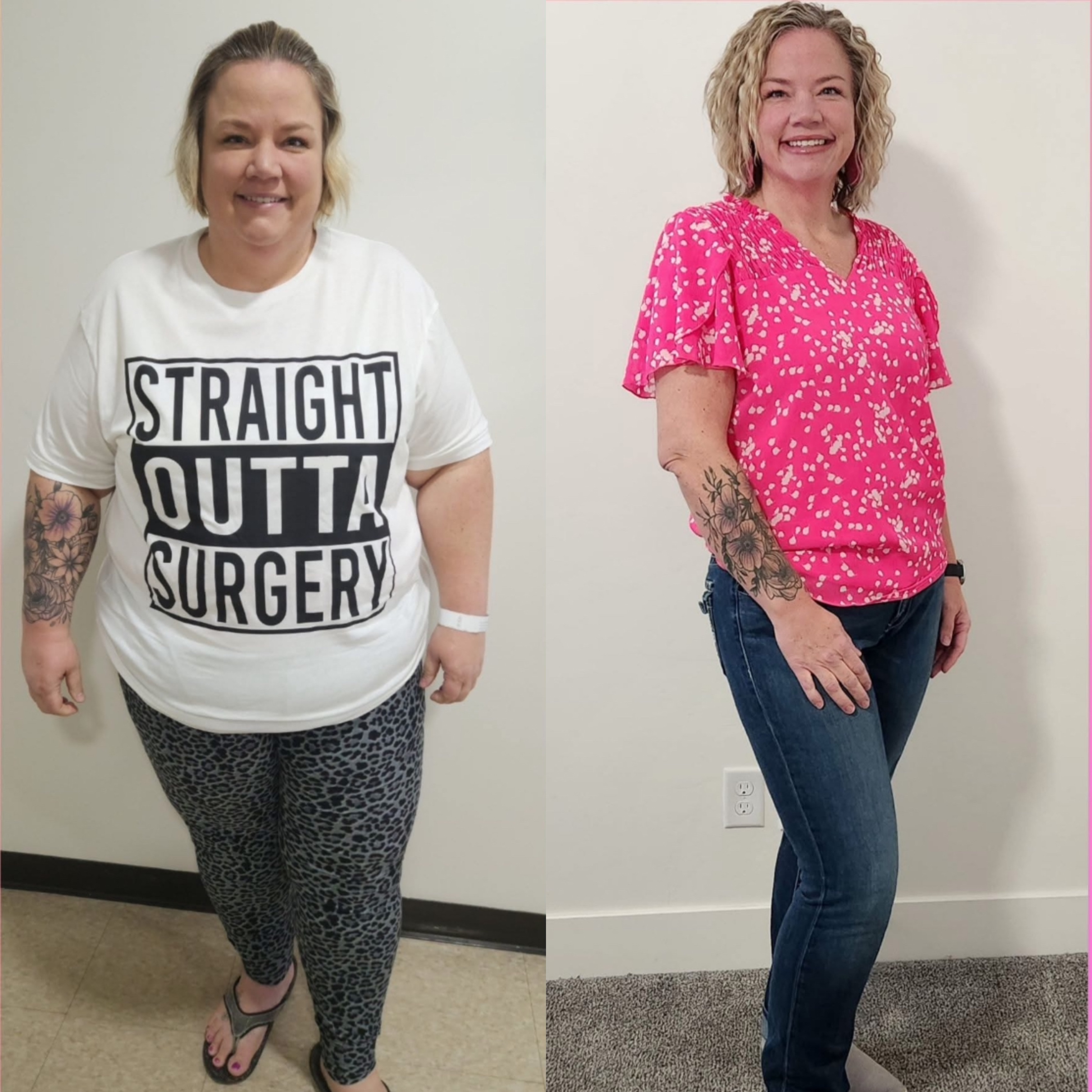 Bariatric Surgery Before & After Gallery - Patient 496276 - Image 1