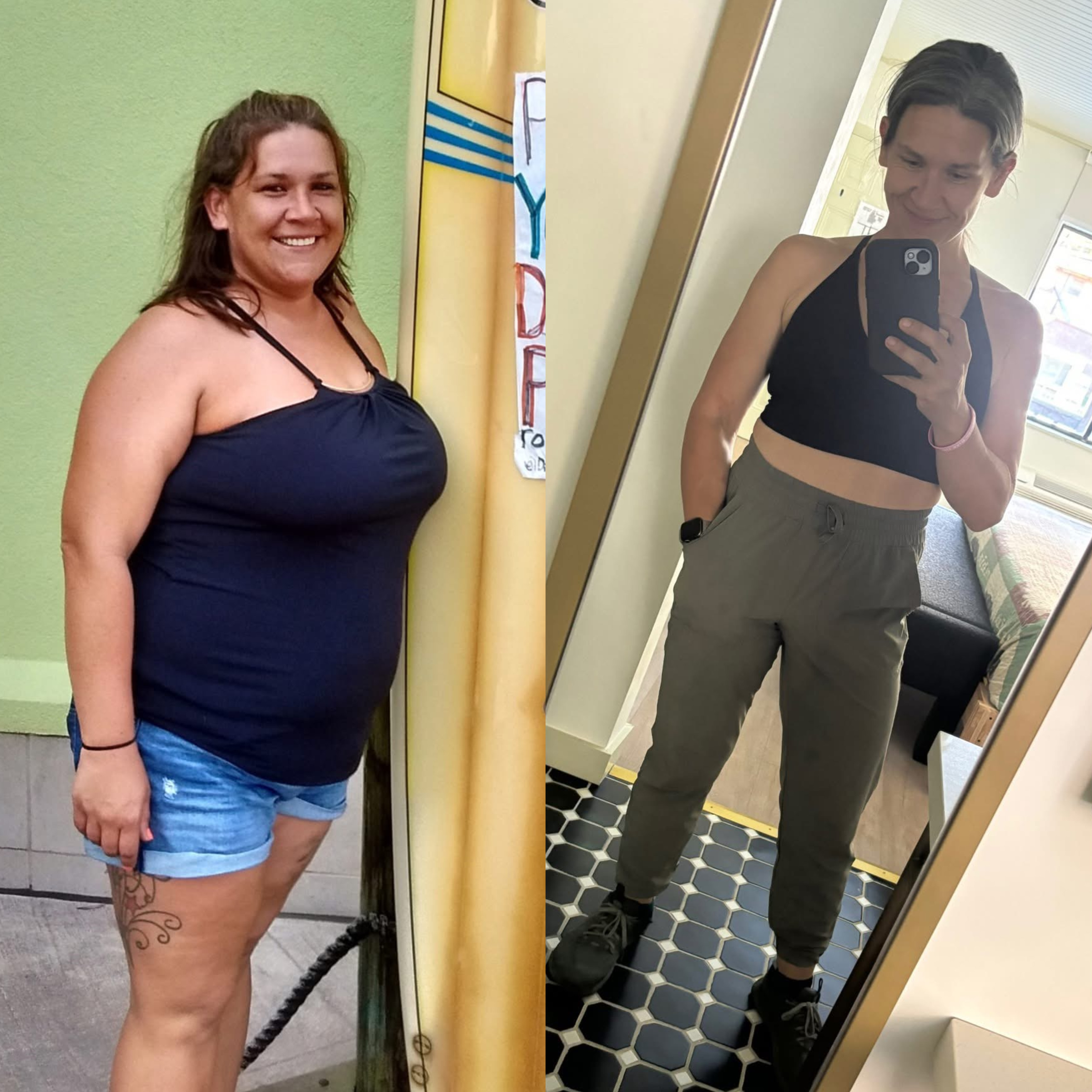 Bariatric Surgery Before & After Gallery - Patient 779602 - Image 1