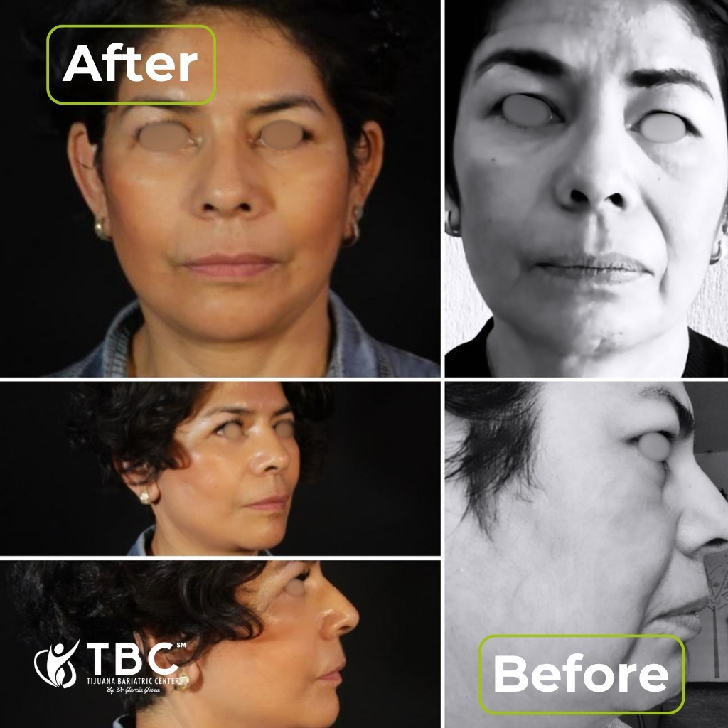 Plastic surgery before and after result in Tijuana