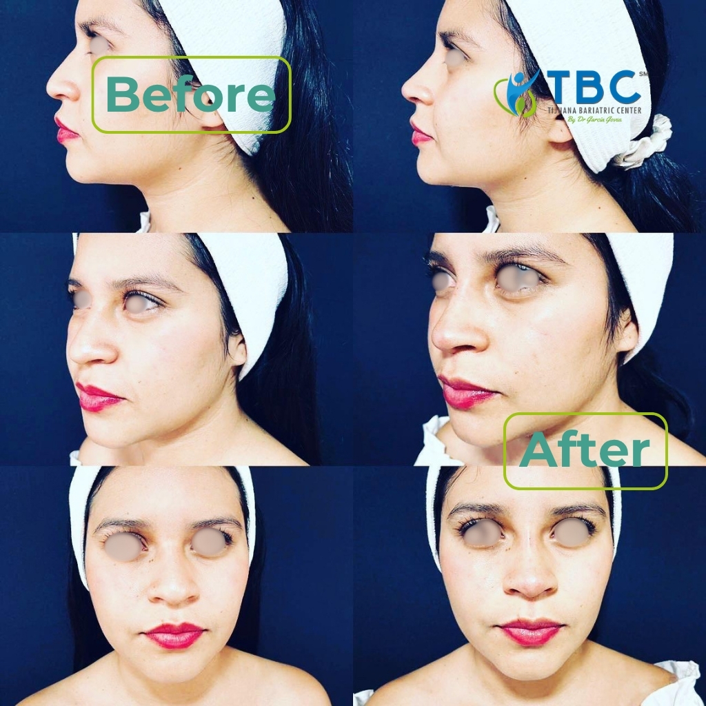 Plastic surgery patient transformation before and after