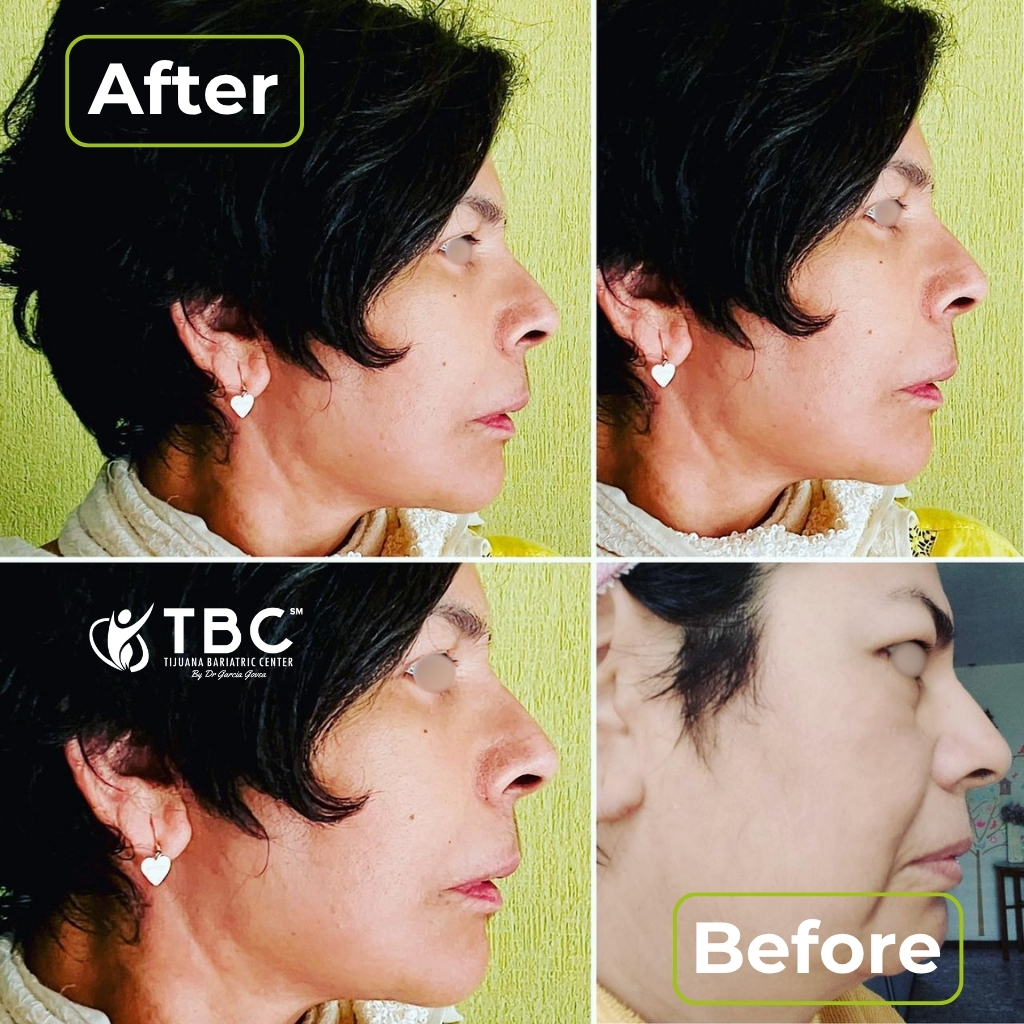 Before and after plastic surgery patient result