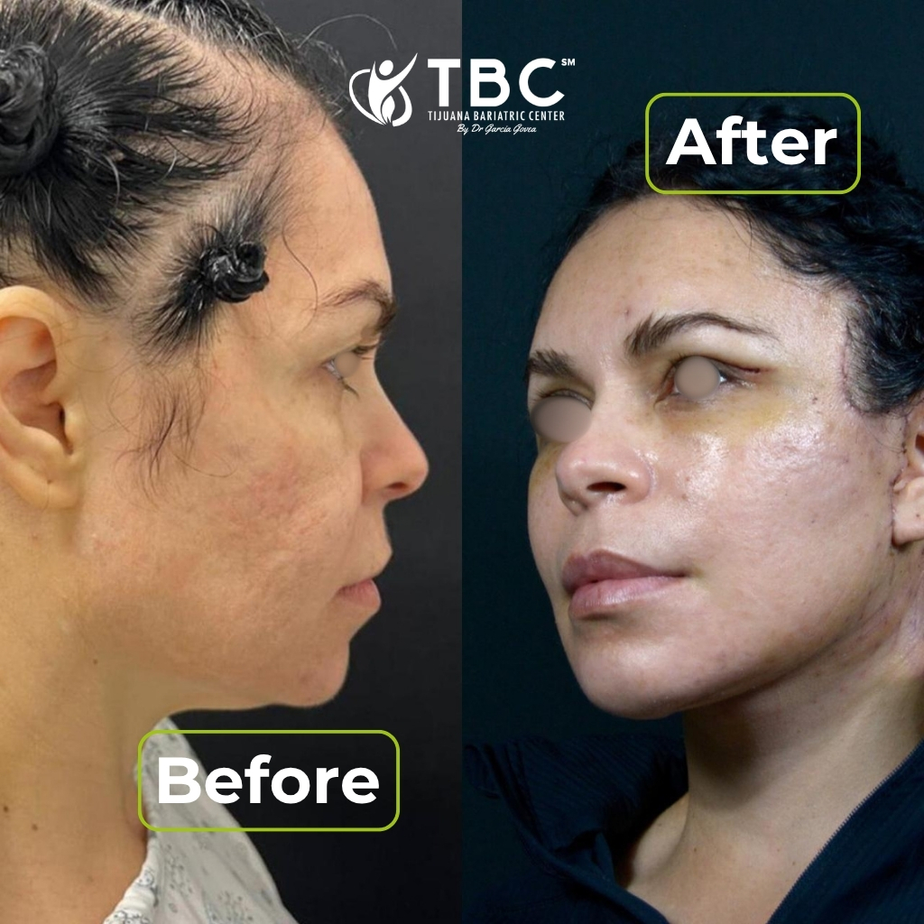 Plastic surgery before and after transformation in Tijuana