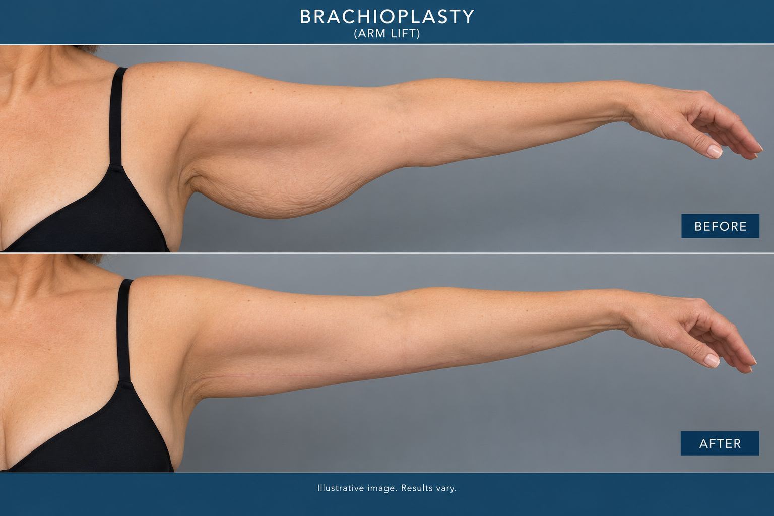 Arm lift before and after result