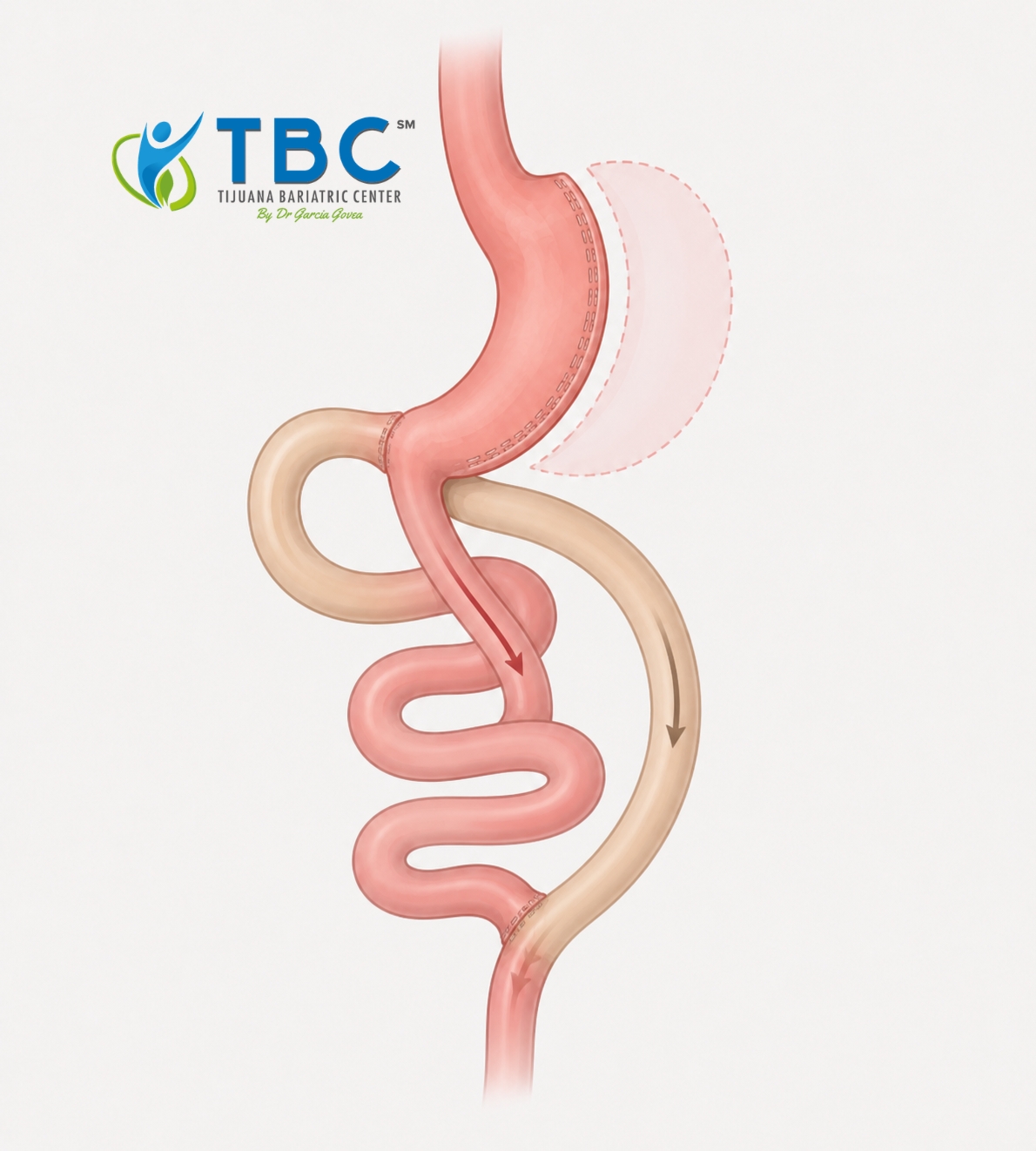glp 1 tijuana Break Through Your Weight Loss Plateau with Semaglutide in at Renovo Health and Beauty Metabolic Bariatric Surgery vs. GLP-1