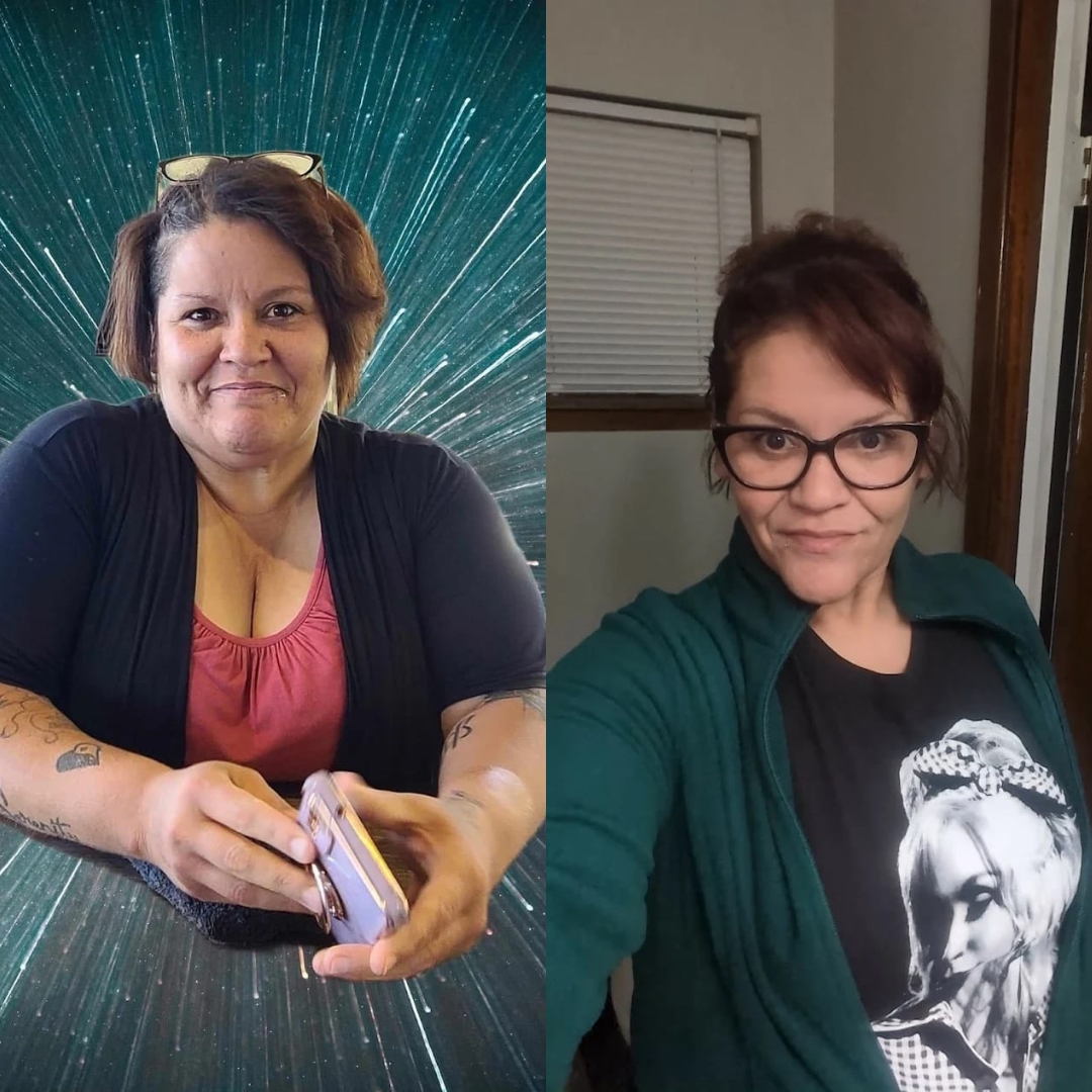 sleeve before after bariatric patient result