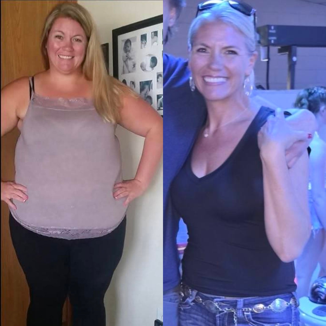 Bariatric surgery before and after patient transformation
