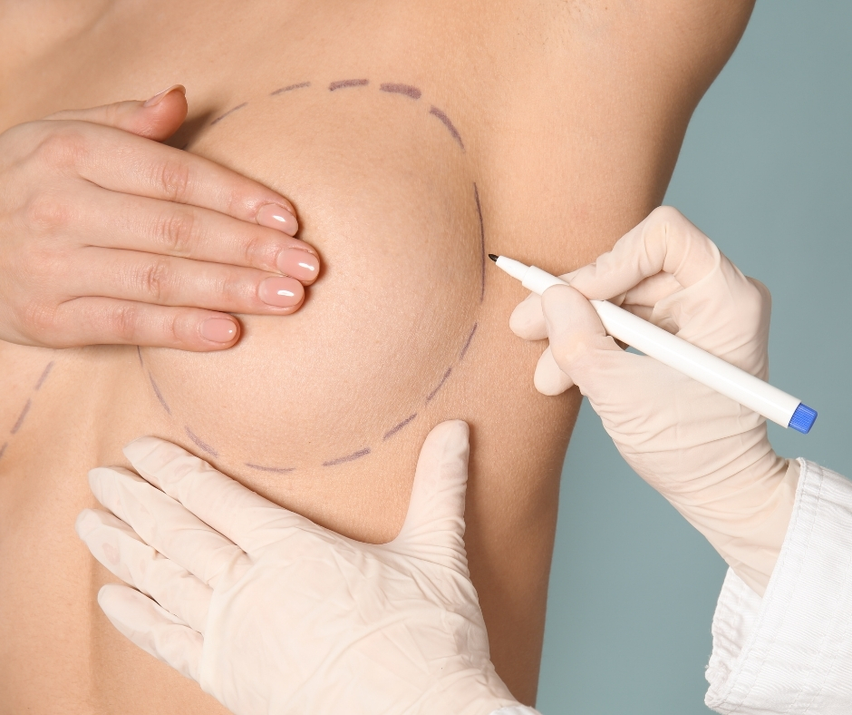 Breast augmentation consultation in Tijuana Mexico