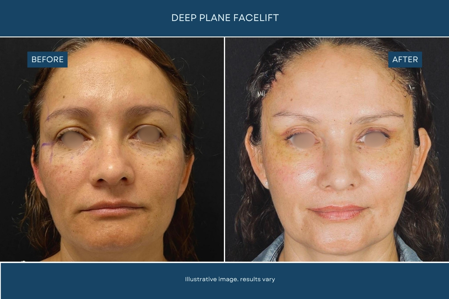 Plastic surgery before and after patient result