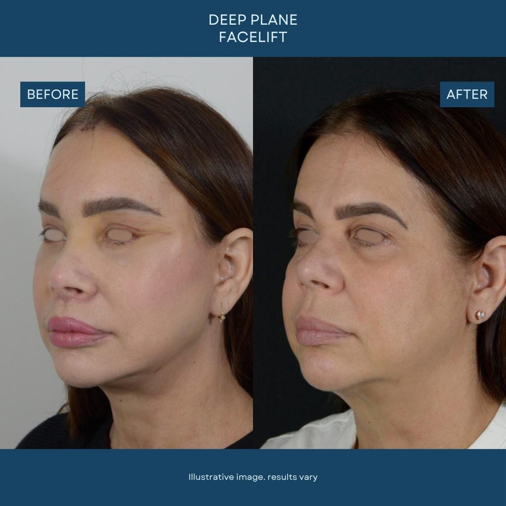 Plastic surgery before and after patient photo