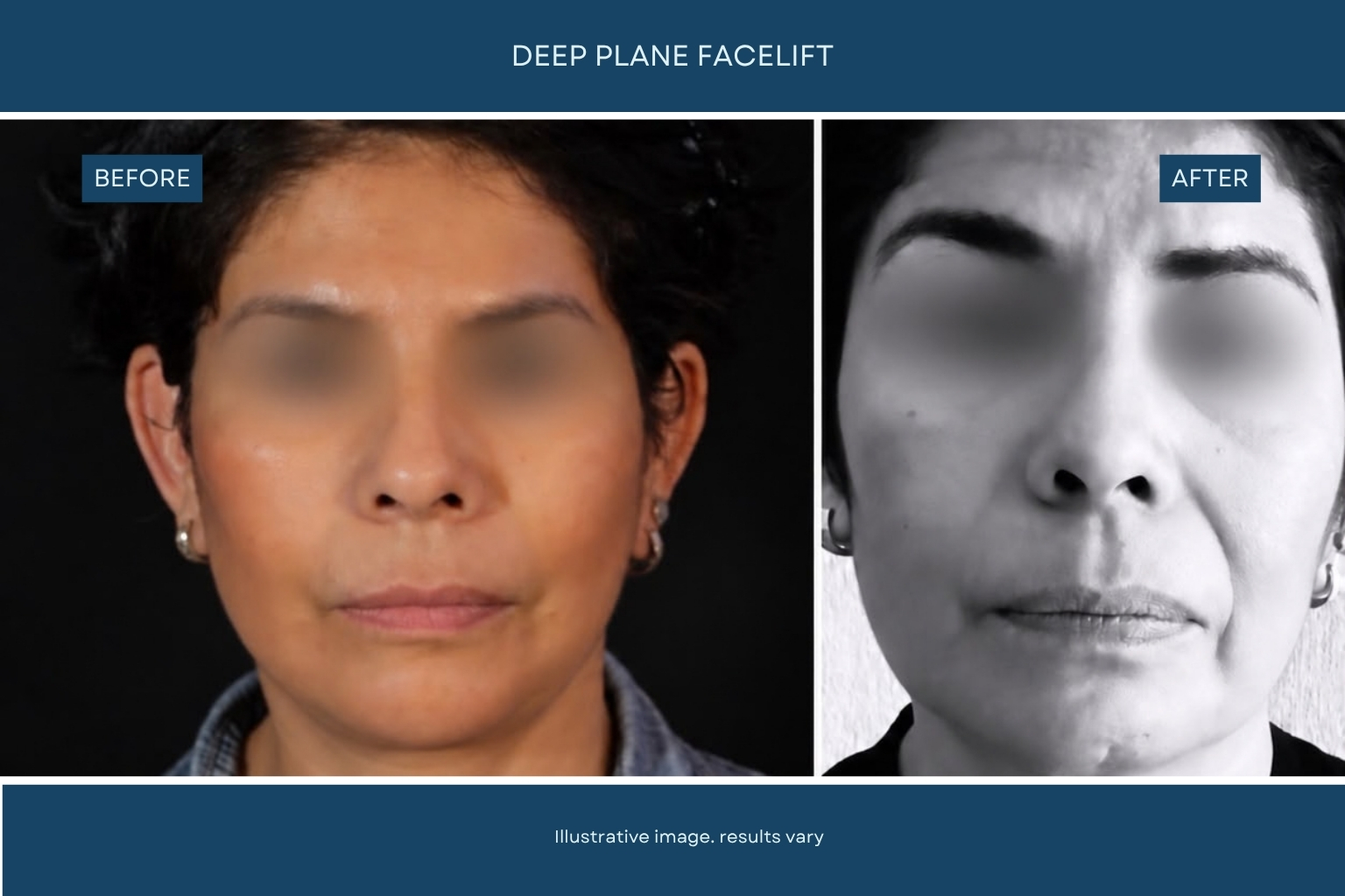Plastic surgery before and after result in Tijuana