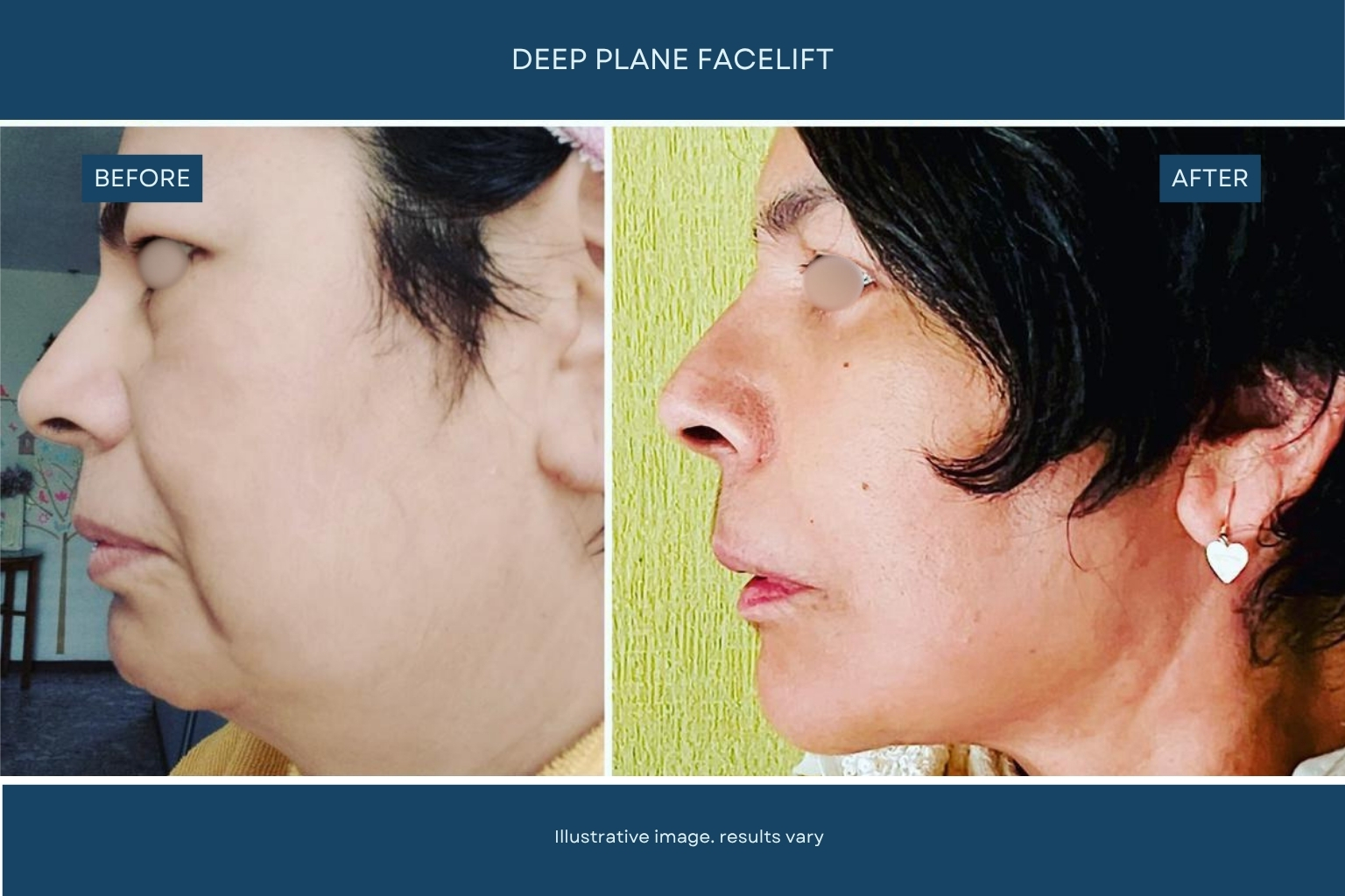 Before and after plastic surgery patient result