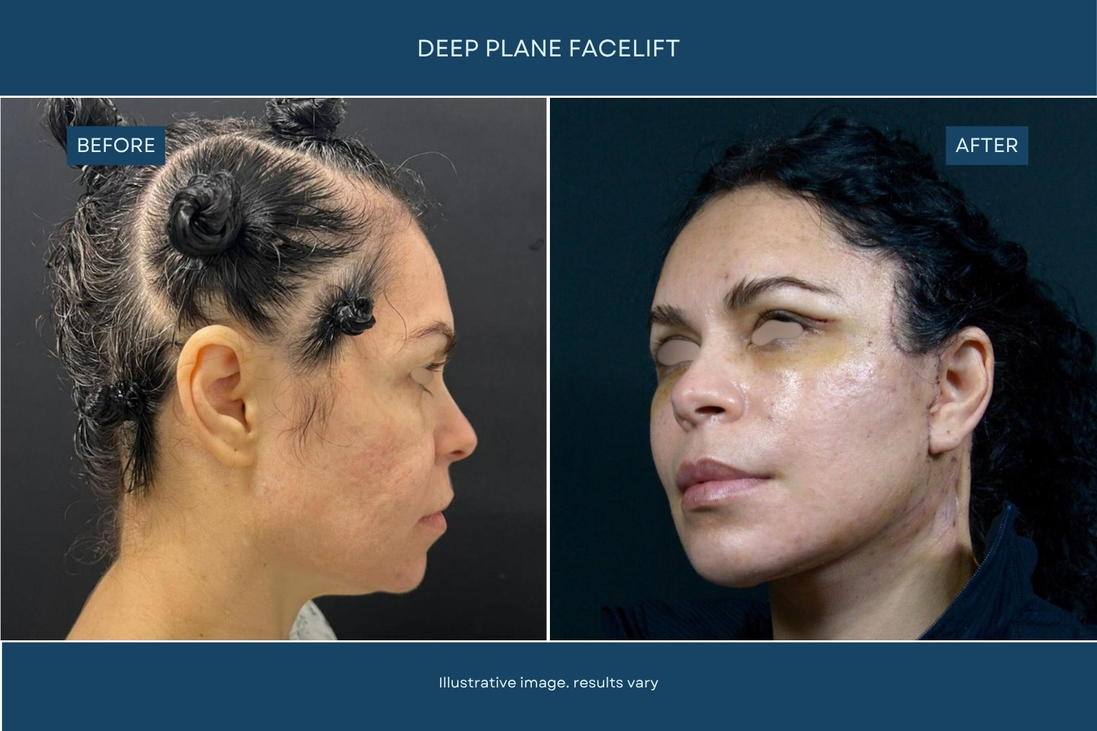 Plastic surgery before and after transformation in Tijuana