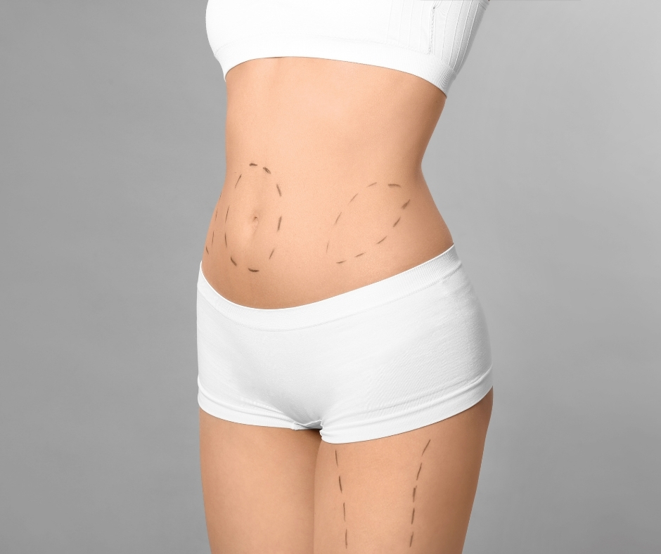 Mommy Makeover consultation in Tijuana Mexico