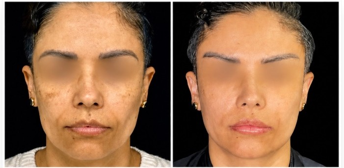 Plastic surgery before and after patient result