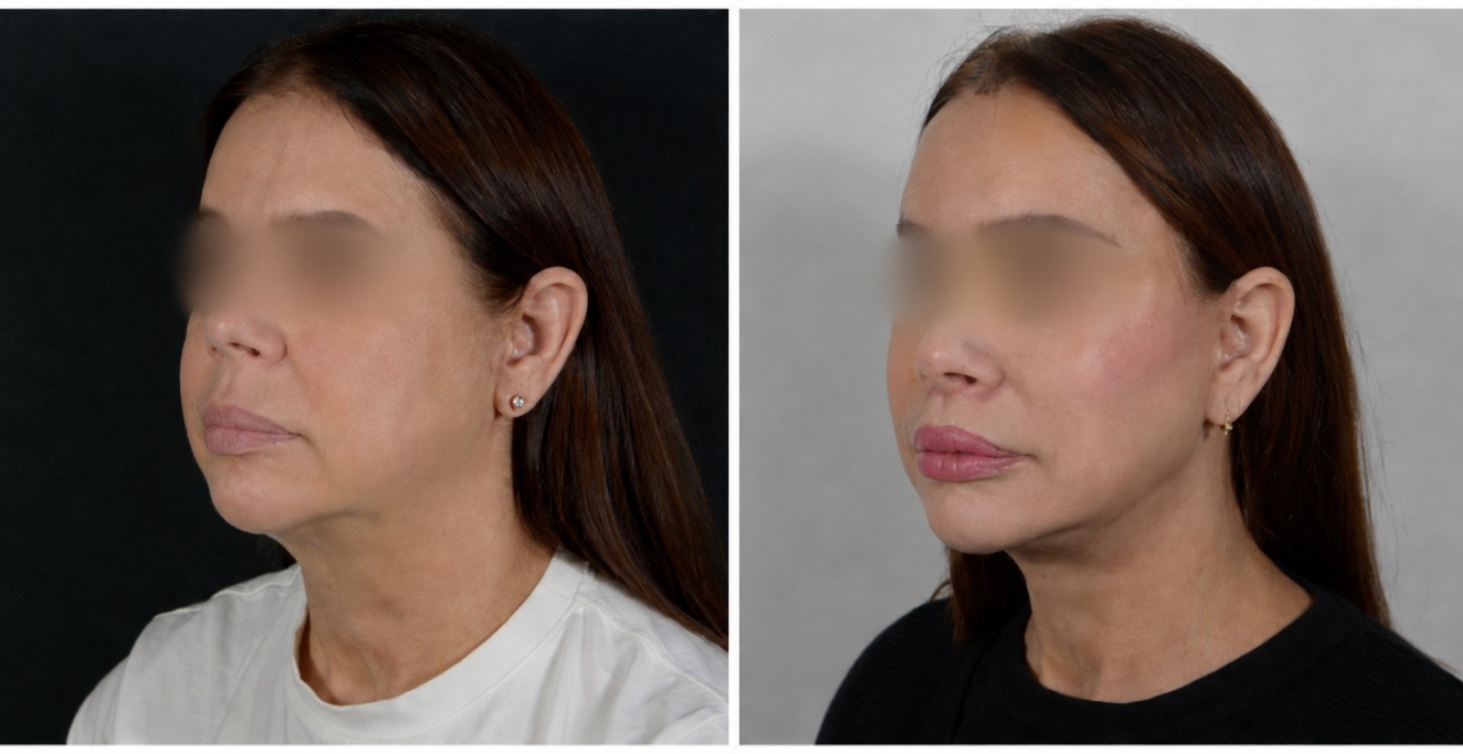 Plastic surgery before and after transformation