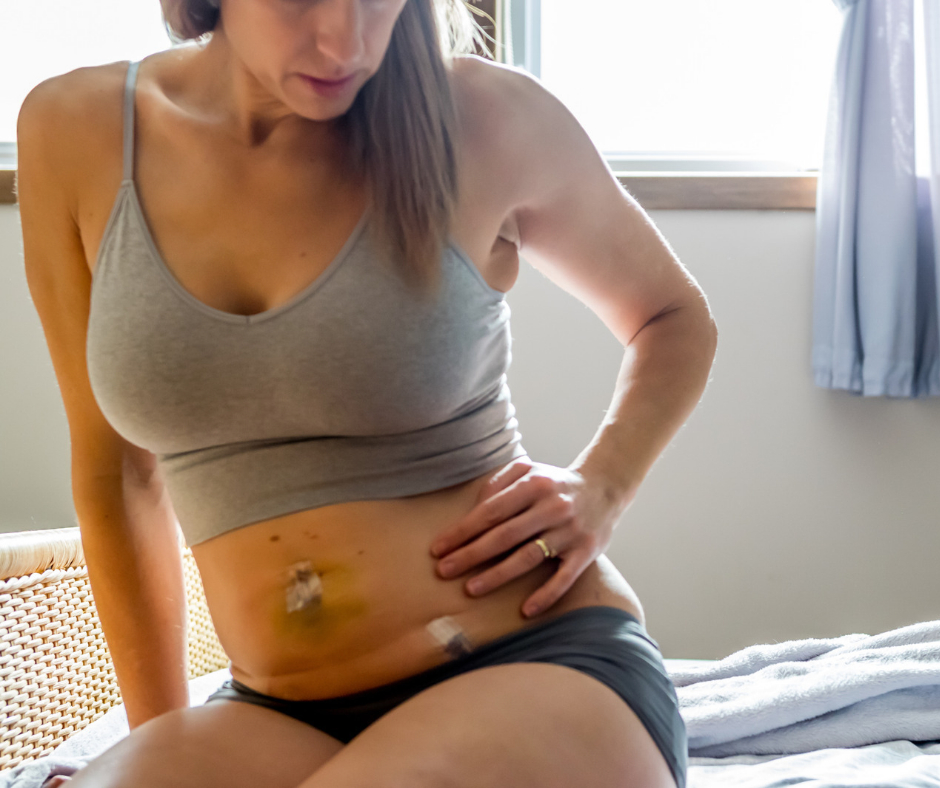Plastic surgery recovery planning in Tijuana