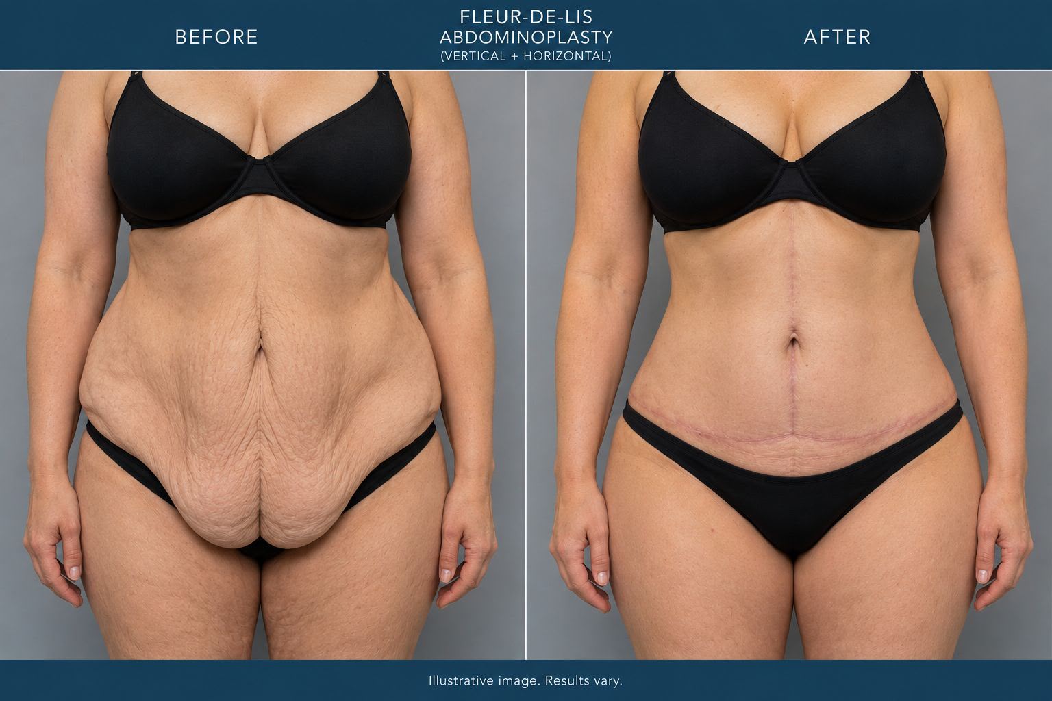 Tummy tuck before and after result